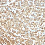 FFPE human melanoma sections stained with 100 ul anti-S100A1 (clone 4C4.9) at 1:200. HIER epitope retrieval prior to staining was performed in 10mM Citrate, pH 6.0.